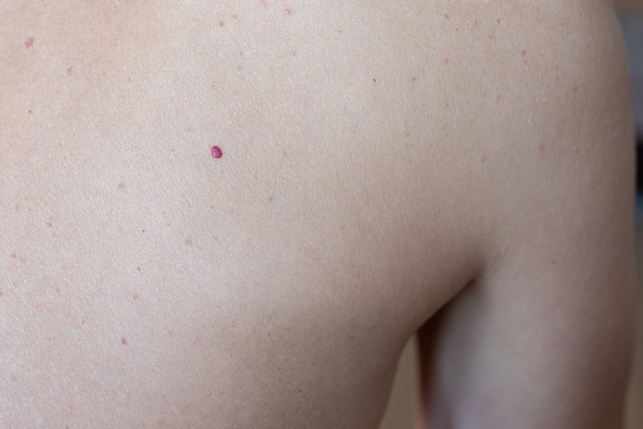 photo of cherry angioma on a teenager's back.